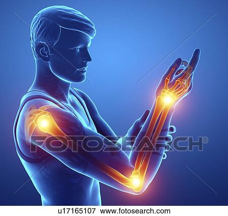 Stock Photo - Man with arm pain, computer illustration.. Fotosearch