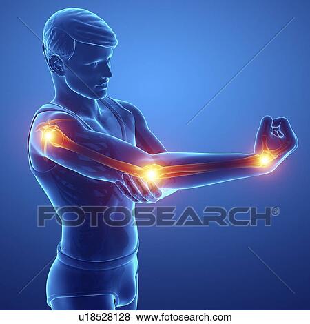 Stock Photo - Man with arm pain, computer illustration.. Fotosearch