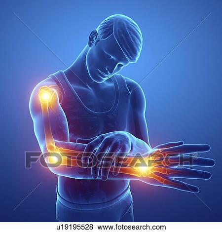 Stock Photo - Man with arm pain, computer illustration.. Fotosearch