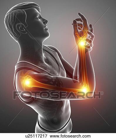 Stock Photo - Man with arm pain, computer illustration.. Fotosearch