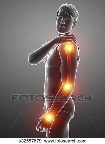 Stock Photo - Man with arm pain, computer illustration.. Fotosearch