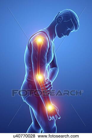 Stock Photo - Man with arm pain, computer illustration.. Fotosearch