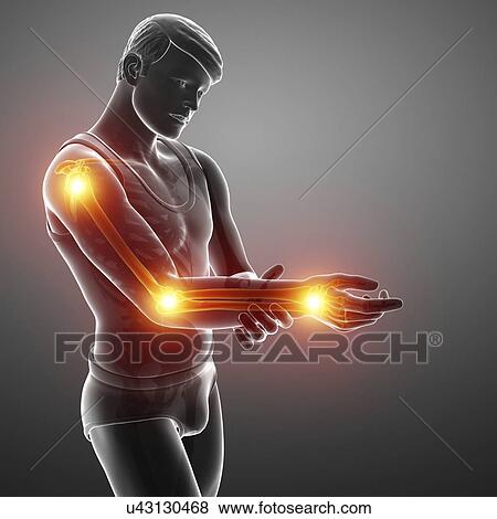 Stock Photo - Man with arm pain, computer illustration.. Fotosearch