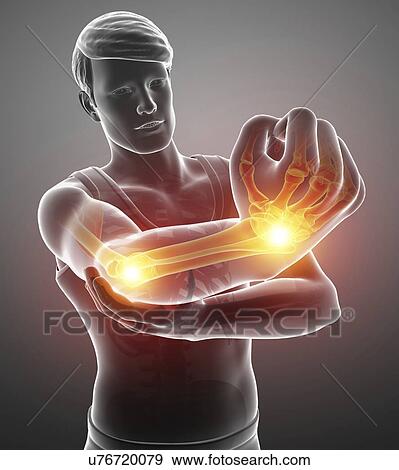 Stock Photo - Man with arm pain, computer illustration.. Fotosearch
