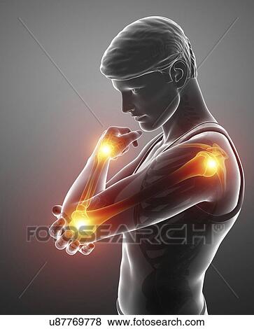 Stock Photo - Man with arm pain, computer illustration.. Fotosearch