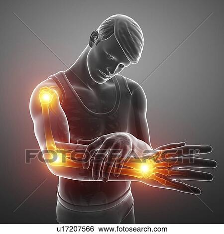 Stock Photograph - Man with arm pain, computer illustration.. Fotosearch