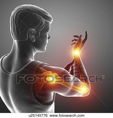 Stock Photograph - Man with arm pain, computer illustration.. Fotosearch