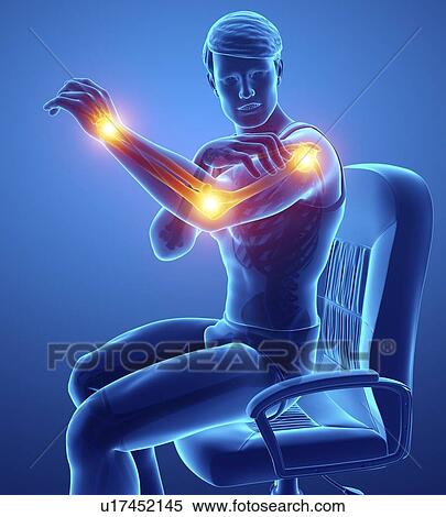 Stock Photography - Man with arm pain, computer illustration.. Fotosearch