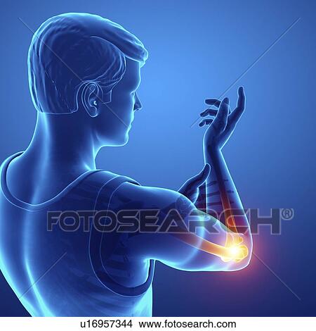 Picture - Man with elbow pain, computer illustration.. Fotosearch