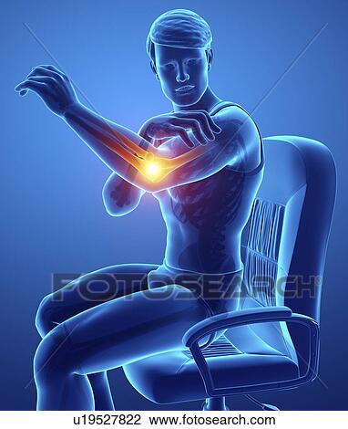 Stock Image - Man with elbow pain, computer illustration.. Fotosearch