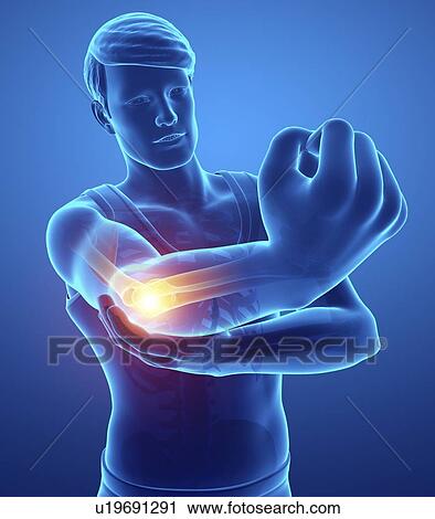 Man with elbow pain, computer illustration. View Large Photo Image Stock Image - Man with elbow pain, computer illustration.. Fotosearch