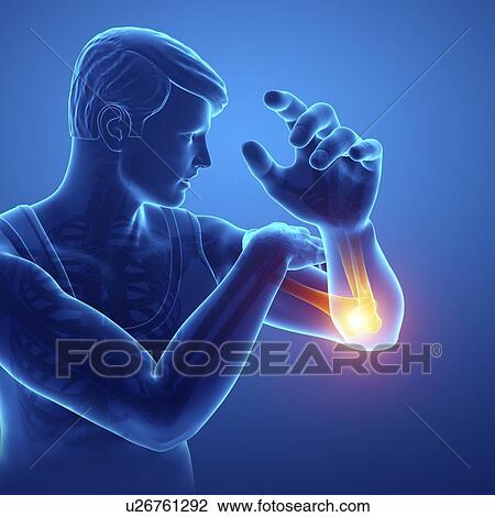 Stock Image - Man with elbow pain, computer illustration.. Fotosearch