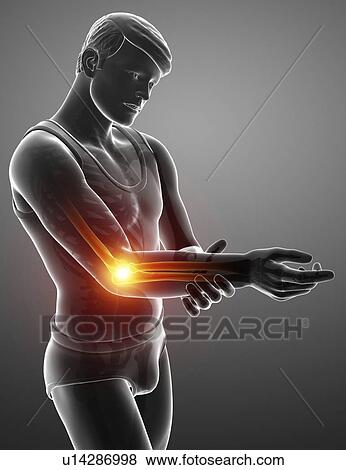 Man with elbow pain, computer illustration. View Large Photo Image Stock Photo - Man with elbow pain, computer illustration.. Fotosearch