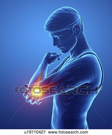 Stock Photo - Man with elbow pain, computer illustration.. Fotosearch