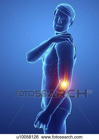Stock Photograph - Man with elbow pain, computer illustration.. Fotosearch