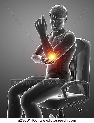 Man with elbow pain, computer illustration. View Large Photo Image Stock Photograph - Man with elbow pain, computer illustration.. Fotosearch