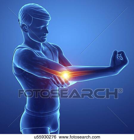Stock Photograph - Man with elbow pain, computer illustration.. Fotosearch