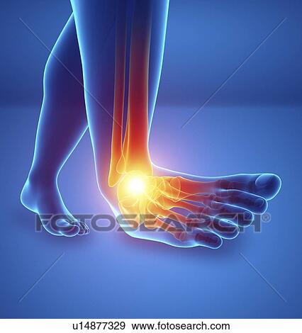 Stock Photo - Man with foot pain, computer illustration.. Fotosearch