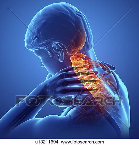 Picture - Man with neck pain, computer illustration.. Fotosearch