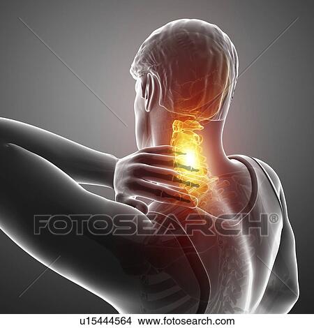 Picture - Man with neck pain, computer illustration.. Fotosearch