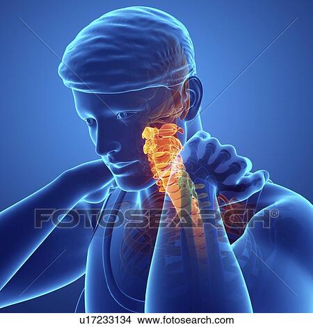 Picture - Man with neck pain, computer illustration.. Fotosearch