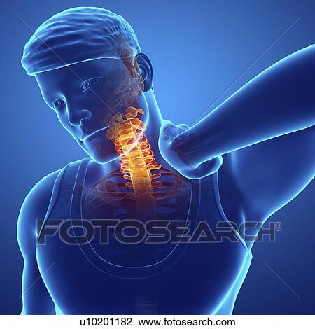 Stock Image - Man with neck pain, computer illustration.. Fotosearch