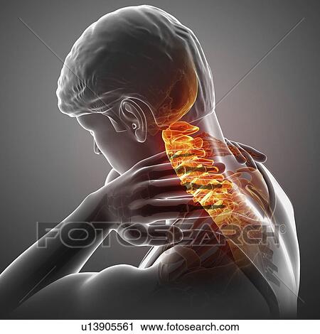 Stock Image - Man with neck pain, computer illustration.. Fotosearch