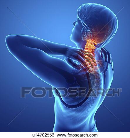 Stock Image - Man with neck pain, computer illustration.. Fotosearch
