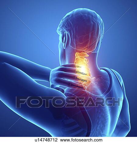 Man with neck pain, computer illustration. View Large Photo Image Stock Image - Man with neck pain, computer illustration.. Fotosearch