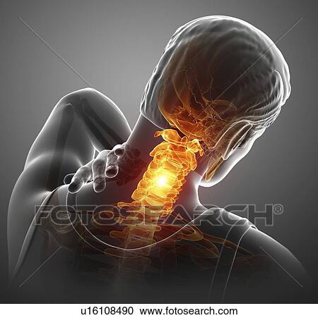 Stock Image - Man with neck pain, computer illustration.. Fotosearch