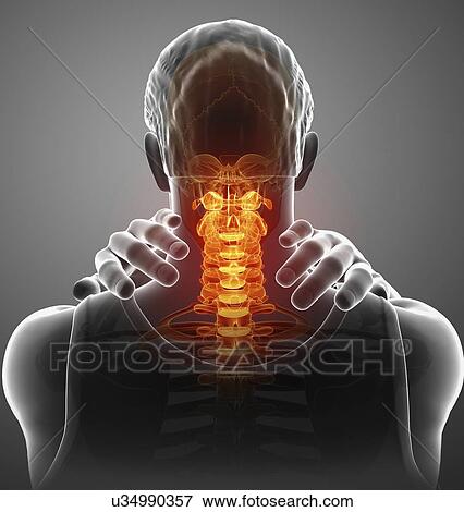 Stock Photo - Man with neck pain, computer illustration.. Fotosearch
