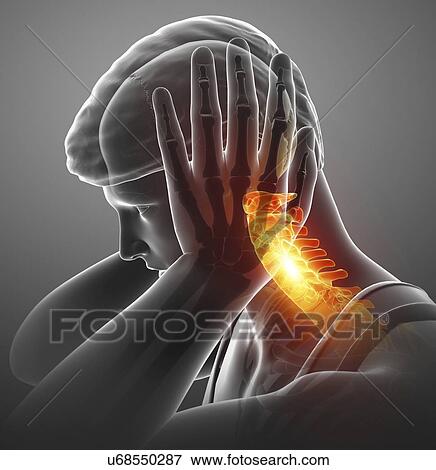 Stock Photo - Man with neck pain, computer illustration.. Fotosearch