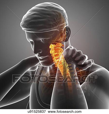 Stock Photo - Man with neck pain, computer illustration.. Fotosearch