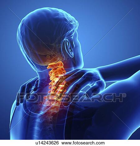 Man with neck pain, computer illustration. View Large Photo Image Stock Photograph - Man with neck pain, computer illustration.. Fotosearch