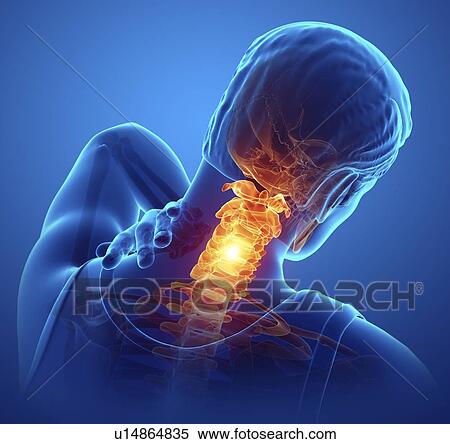 Stock Photography - Man with neck pain, computer illustration.. Fotosearch