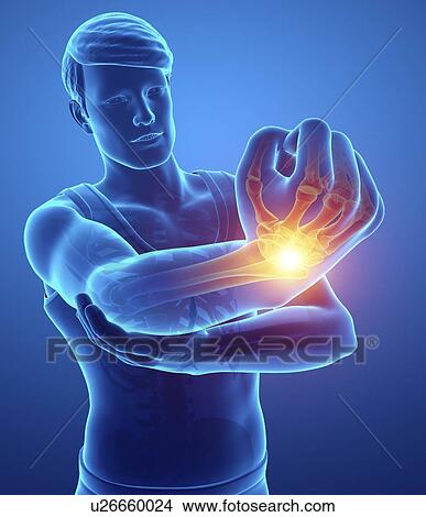 Man with wrist pain, computer illustration. View Large Photo Image Picture - Man with wrist pain, computer illustration.. Fotosearch