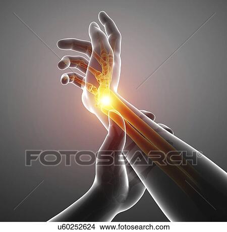 Picture - Man with wrist pain, computer illustration.. Fotosearch