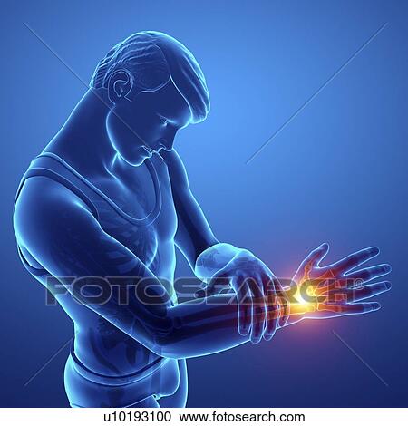 Stock Image - Man with wrist pain, computer illustration.. Fotosearch