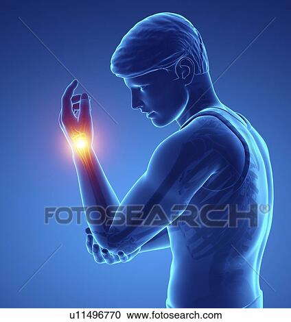 Stock Image - Man with wrist pain, computer illustration.. Fotosearch