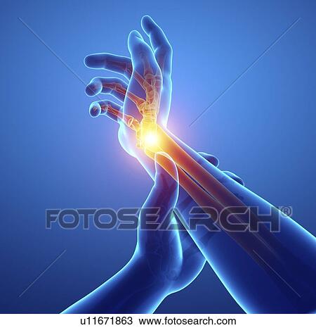 Stock Image - Man with wrist pain, computer illustration.. Fotosearch