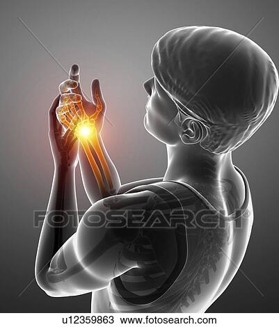 Stock Image - Man with wrist pain, computer illustration.. Fotosearch