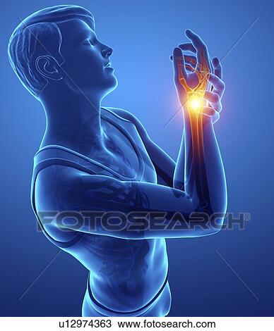 Stock Image - Man with wrist pain, computer illustration.. Fotosearch
