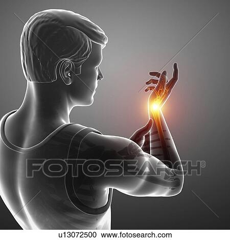 Stock Image - Man with wrist pain, computer illustration.. Fotosearch