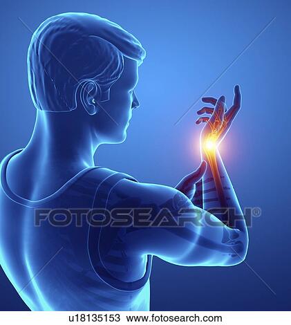Stock Image - Man with wrist pain, computer illustration.. Fotosearch