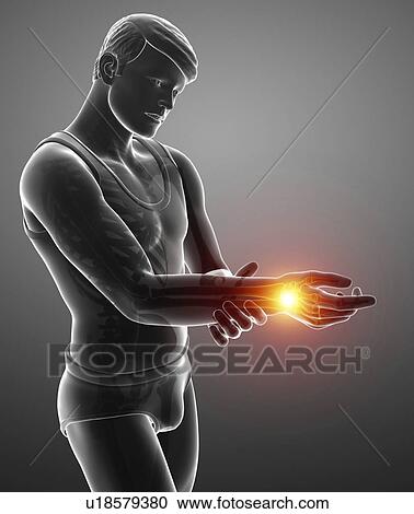 Stock Image - Man with wrist pain, computer illustration.. Fotosearch
