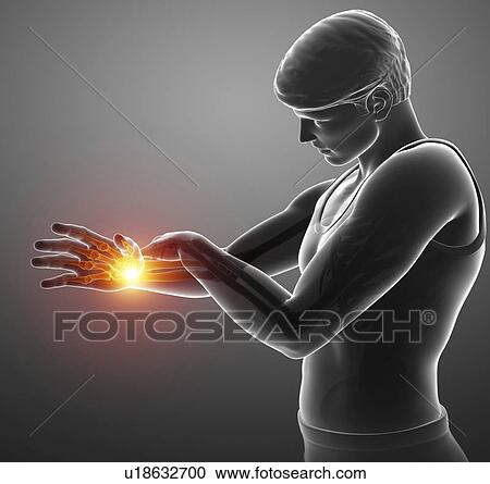 Man with wrist pain, computer illustration. View Large Photo Image Stock Image - Man with wrist pain, computer illustration.. Fotosearch