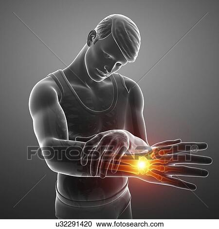 Stock Image - Man with wrist pain, computer illustration.. Fotosearch