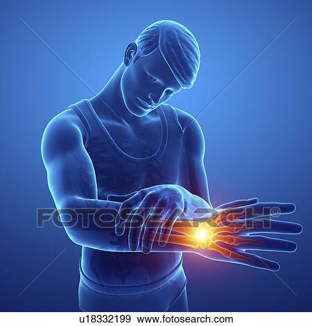 Stock Photo - Man with wrist pain, computer illustration.. Fotosearch