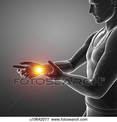 Stock Photo - Man with wrist pain, computer illustration.. Fotosearch