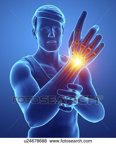 Stock Photo - Man with wrist pain, computer illustration.. Fotosearch